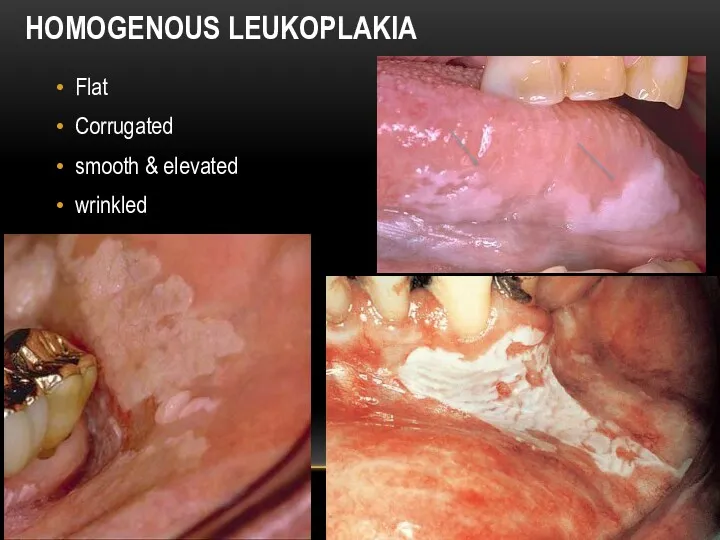 HOMOGENOUS LEUKOPLAKIA Flat Corrugated smooth & elevated wrinkled