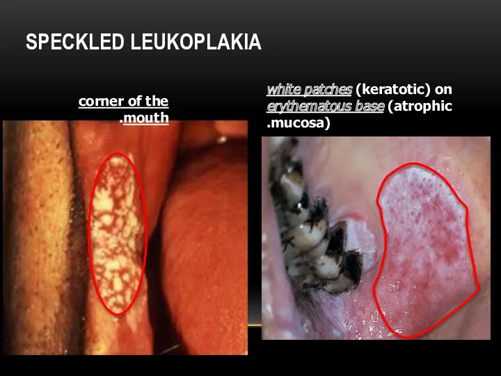 SPECKLED LEUKOPLAKIA corner of the mouth. white patches (keratotic) on erythematous base (atrophic mucosa).
