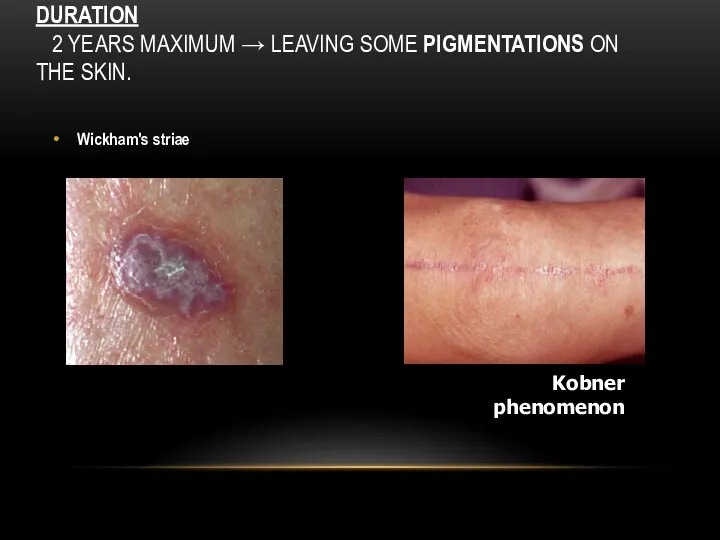 DURATION 2 YEARS MAXIMUM → LEAVING SOME PIGMENTATIONS ON THE SKIN. Wickham's striae Kobner phenomenon