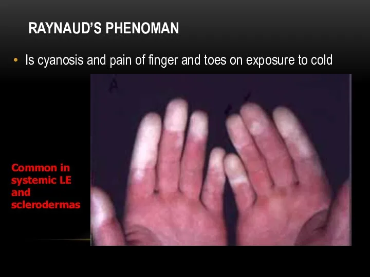 RAYNAUD’S PHENOMAN Is cyanosis and pain of finger and toes