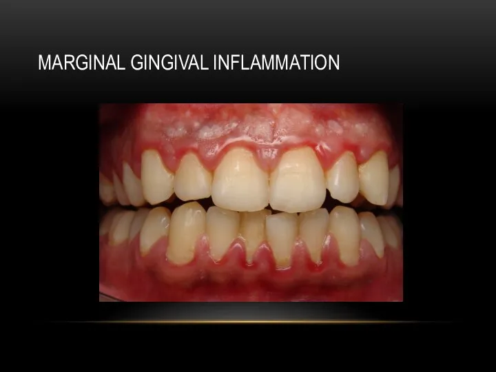 MARGINAL GINGIVAL INFLAMMATION