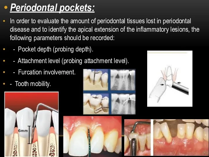 Periodontal pockets: In order to evaluate the amount of periodontal