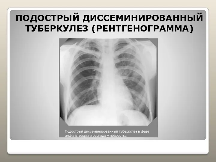 ПОДОСТРЫЙ ДИССЕМИНИРОВАННЫЙ ТУБЕРКУЛЕЗ (РЕНТГЕНОГРАММА)