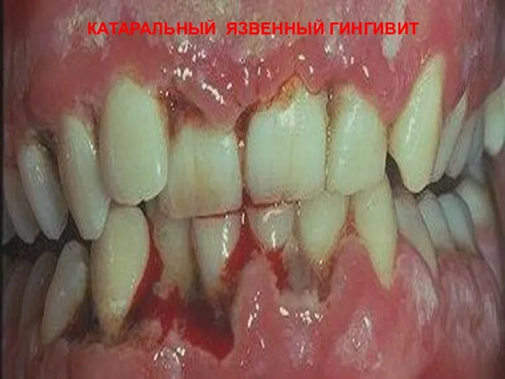 КАТАРАЛЬНЫЙ ЯЗВЕННЫЙ ГИНГИВИТ