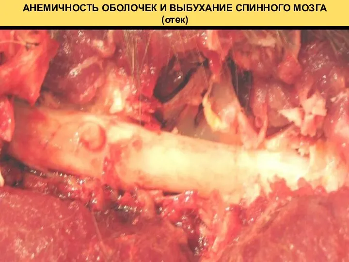 АНЕМИЧНОСТЬ ОБОЛОЧЕК И ВЫБУХАНИЕ СПИННОГО МОЗГА (отек)