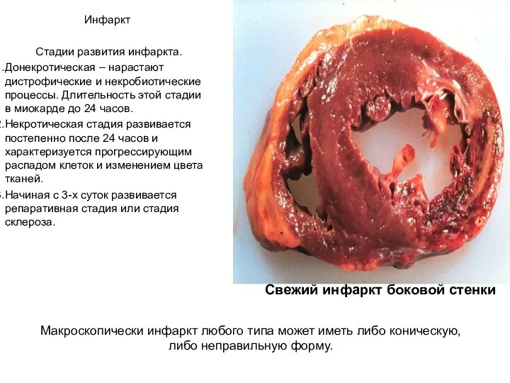 Инфаркт Стадии развития инфаркта. Донекротическая – нарастают дистрофические и некробиотические
