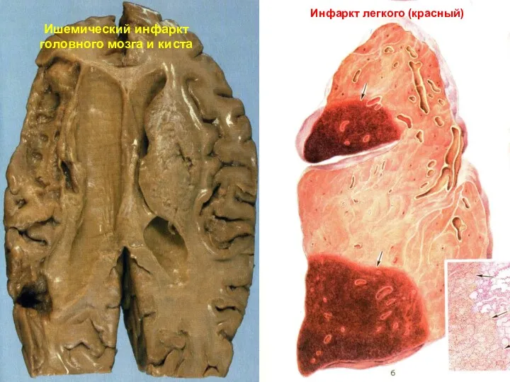 Ишемический инфаркт головного мозга и киста Инфаркт легкого (красный)