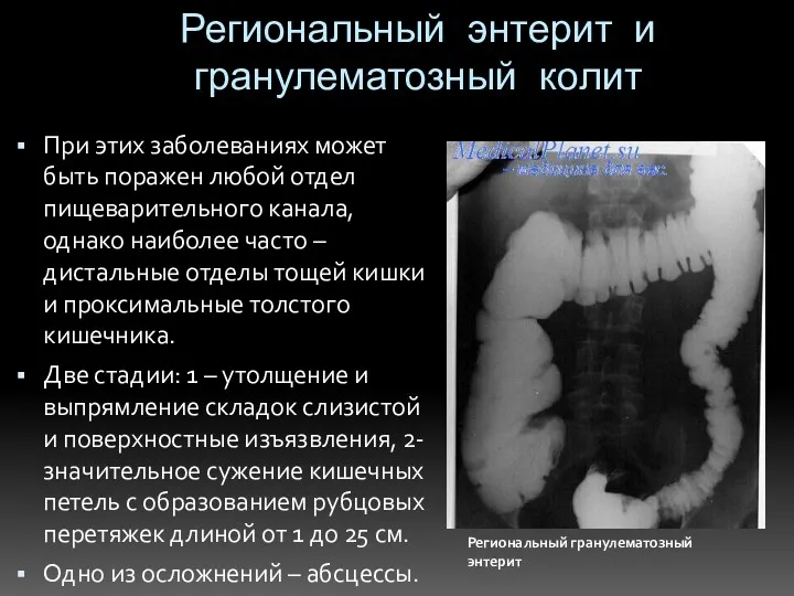 Региональный энтерит и гранулематозный колит При этих заболеваниях может быть