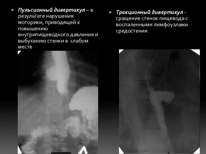 Пульсионный дивертикул – в результате нарушения моторики, приводящей к повышению