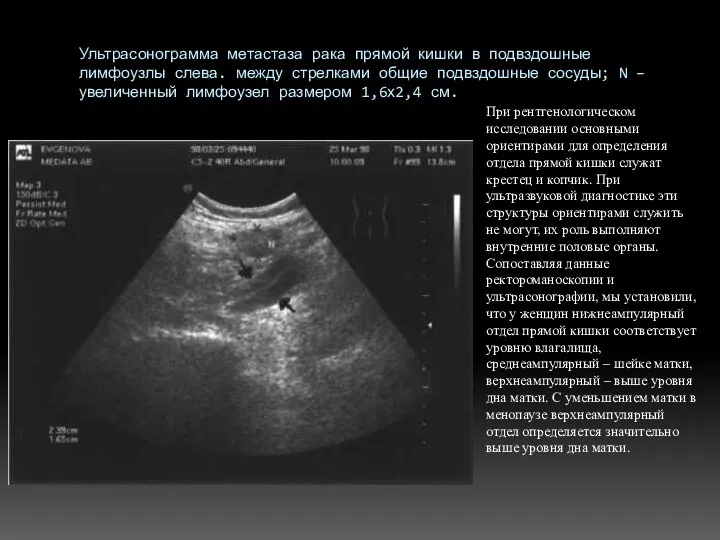 Ультрасонограмма метастаза рака прямой кишки в подвздошные лимфоузлы слева. между