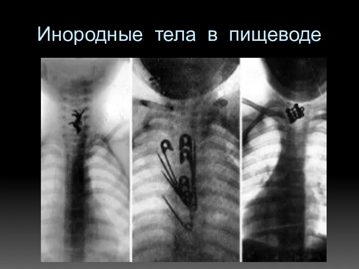 Инородные тела в пищеводе