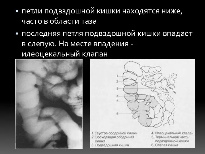 петли подвздошной кишки находятся ниже, часто в области таза последняя