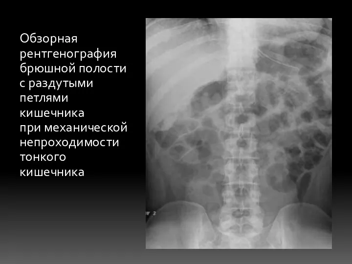 Обзорная рентгенография брюшной полости с раздутыми петлями кишечника при механической непроходимости тонкого кишечника