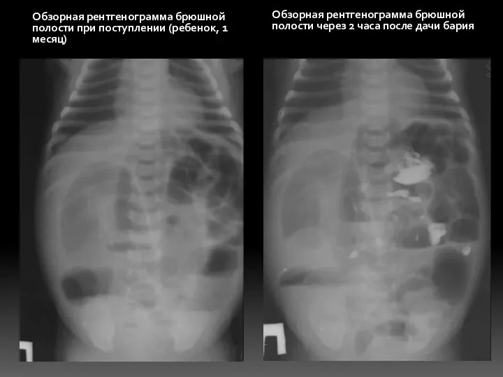 Обзорная рентгенограмма брюшной полости при поступлении (ребенок, 1 месяц) Обзорная