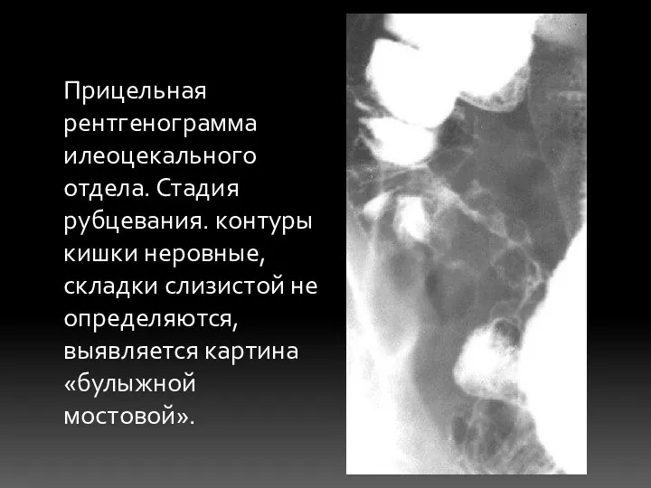 Прицельная рентгенограмма илеоцекального отдела. Стадия рубцевания. контуры кишки неровные, складки