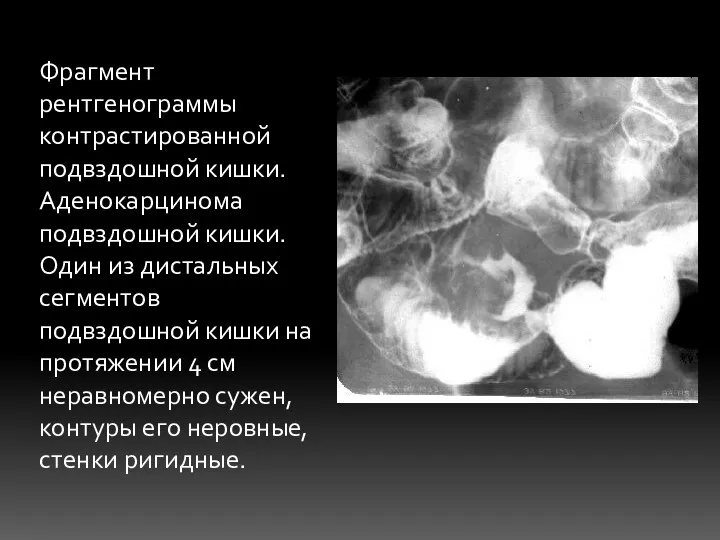 Фрагмент рентгенограммы контрастированной подвздошной кишки. Аденокарцинома подвздошной кишки. Один из