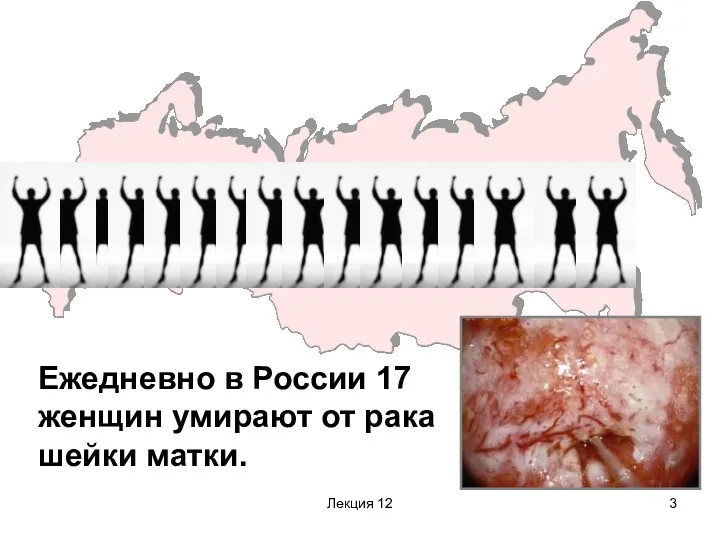 Лекция 12 Ежедневно в России 17 женщин умирают от рака шейки матки.