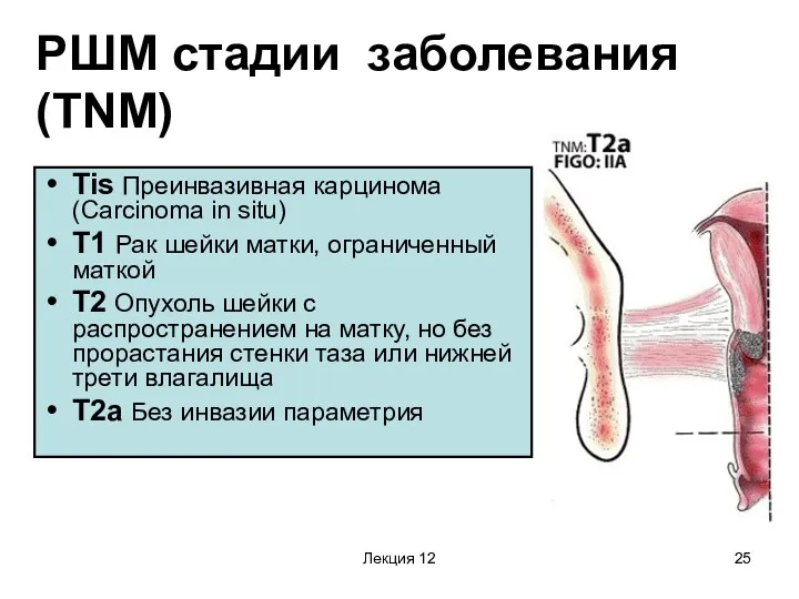Лекция 12 РШМ стадии заболевания (TNM) Tis Преинвазивная карцинома (Carcinoma
