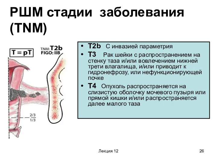 Лекция 12 РШМ стадии заболевания (TNM) T2b С инвазией параметрия