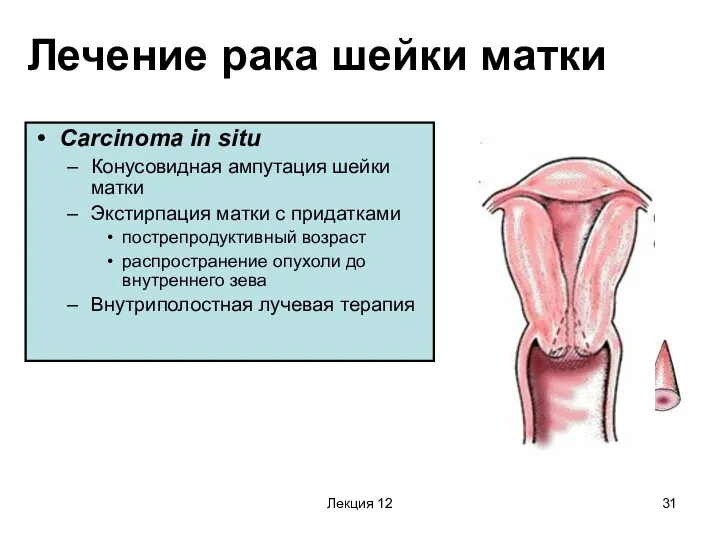 Лекция 12 Лечение рака шейки матки Carcinoma in situ Конусовидная