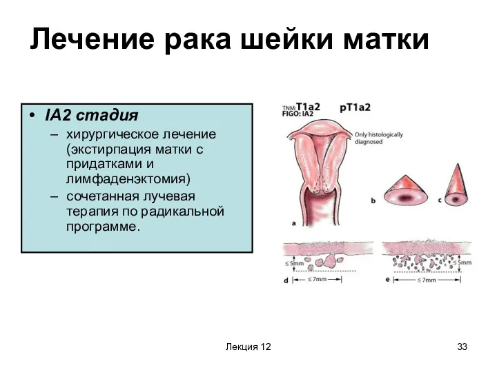 Лекция 12 Лечение рака шейки матки IA2 стадия хирургическое лечение