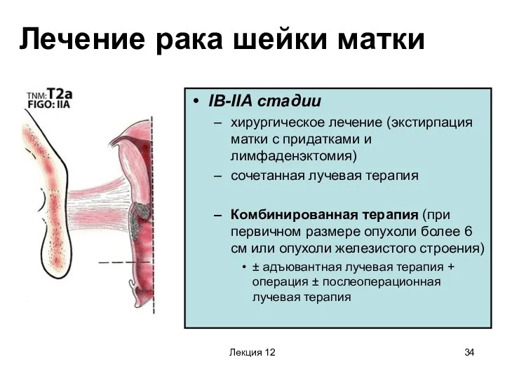 Лекция 12 Лечение рака шейки матки IB-IIA стадии хирургическое лечение