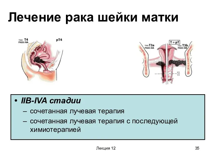 Лекция 12 Лечение рака шейки матки IIB-IVA стадии сочетанная лучевая