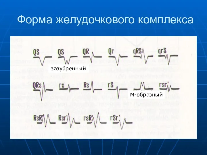 Форма желудочкового комплекса М-образный зазубренный