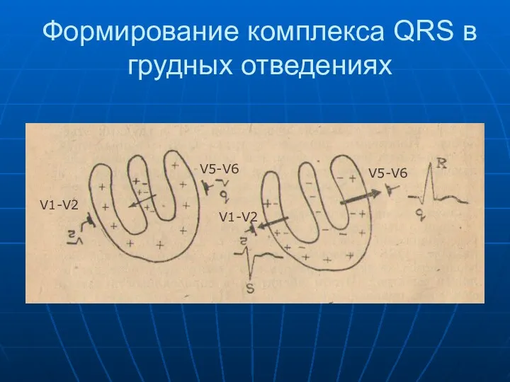 Формирование комплекса QRS в грудных отведениях V1-V2 V1-V2 V5-V6 V5-V6