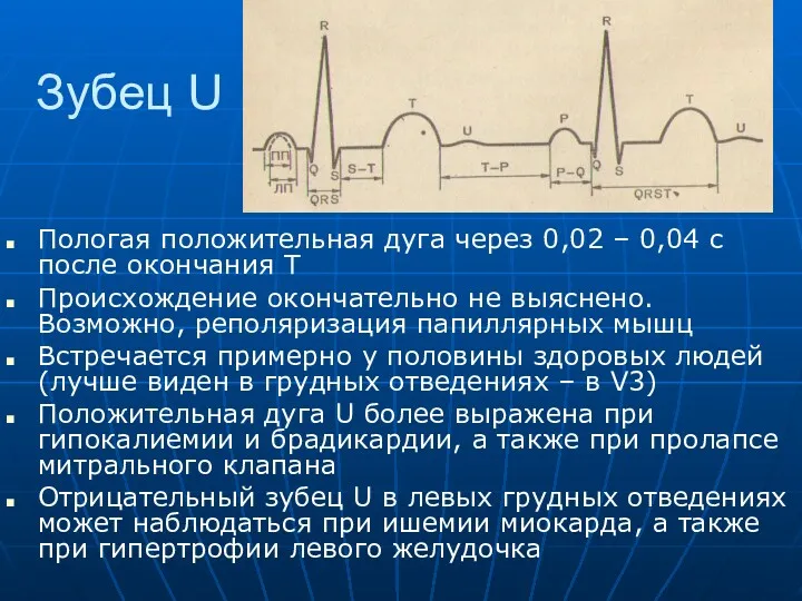 Зубец U Пологая положительная дуга через 0,02 – 0,04 с