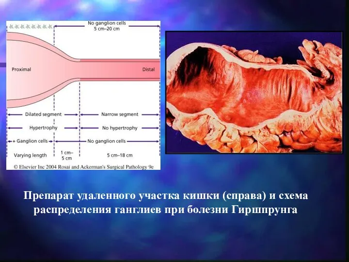 Препарат удаленного участка кишки (справа) и схема распределения ганглиев при болезни Гиршпрунга