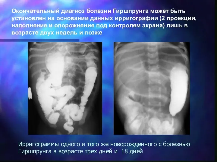 Ирригограммы одного и того же новорожденного с болезнью Гиршпрунга в