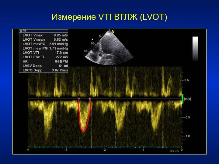 Измерение VTI ВТЛЖ (LVOT)