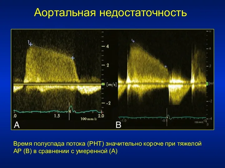 Аортальная недостаточность Время полуспада потока (PHT) значительно короче при тяжелой