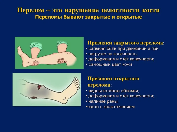 Перелом – это нарушение целостности кости Переломы бывают закрытые и