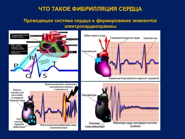 ЧТО ТАКОЕ ФИБРИЛЛЯЦИЯ СЕРДЦА Проводящая система сердца и формирование элементов электрокардиограммы