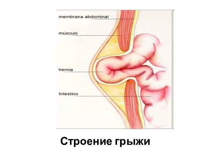 Строение грыжи