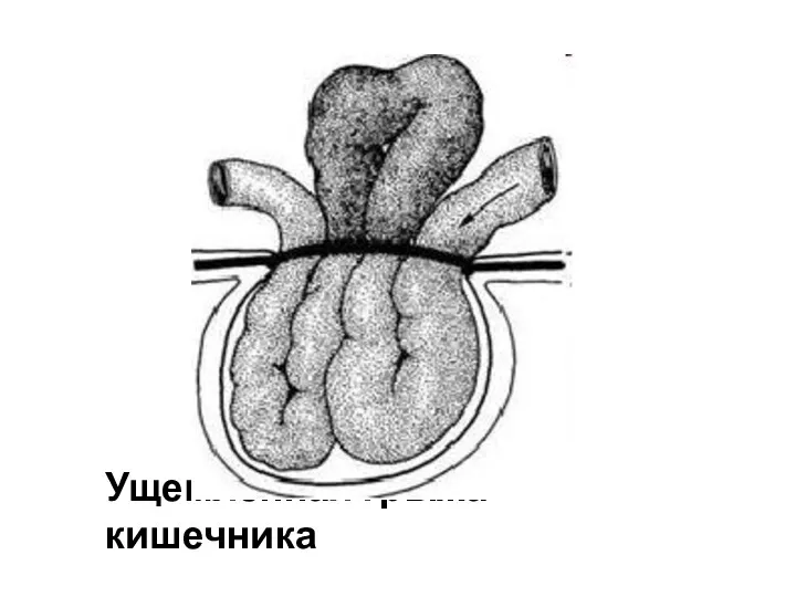 Ущемлённая грыжа кишечника