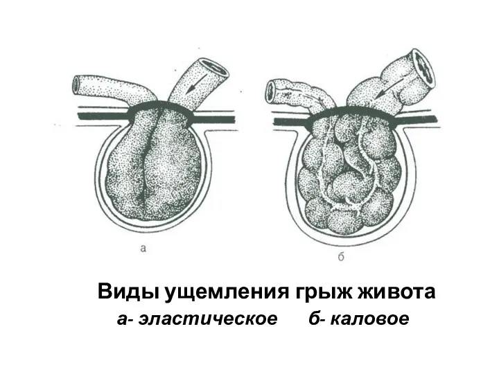 Виды ущемления грыж живота а- эластическое б- каловое