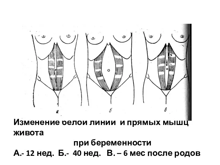 Изменение белой линии и прямых мышц живота при беременности А.-