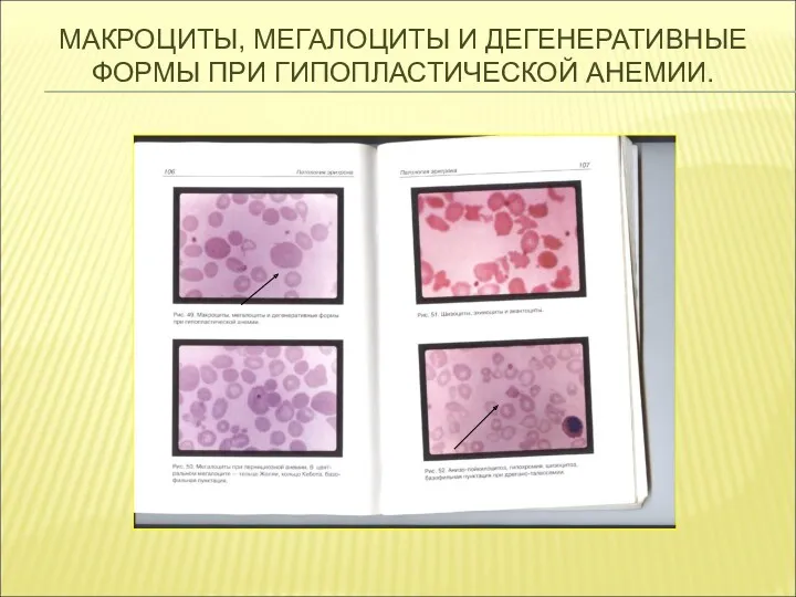 МАКРОЦИТЫ, МЕГАЛОЦИТЫ И ДЕГЕНЕРАТИВНЫЕ ФОРМЫ ПРИ ГИПОПЛАСТИЧЕСКОЙ АНЕМИИ.