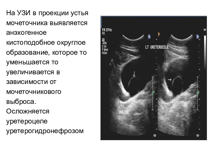 На УЗИ в проекции устья мочеточника выявляется анэхогенное кистоподобное округлое