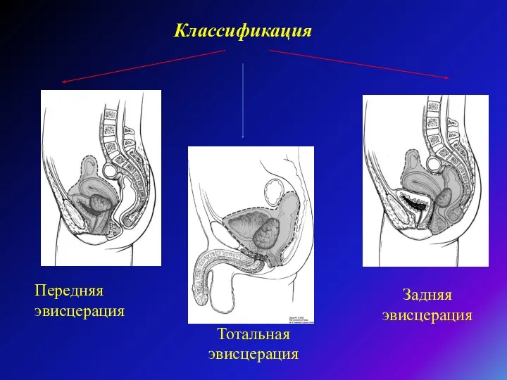 Классификация Передняя эвисцерация Задняя эвисцерация Тотальная эвисцерация