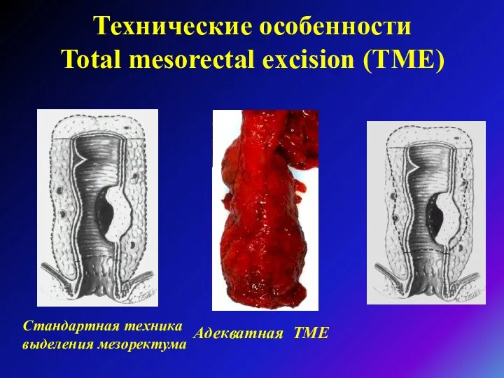 Технические особенности Total mesorectal excision (TME) Стандартная техника выделения мезоректума Адекватная ТМЕ