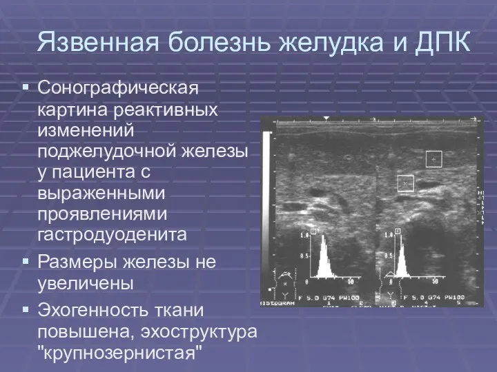 Язвенная болезнь желудка и ДПК Сонографическая картина реактивных изменений поджелудочной