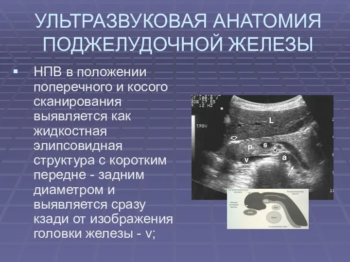 УЛЬТРАЗВУКОВАЯ АНАТОМИЯ ПОДЖЕЛУДОЧНОЙ ЖЕЛЕЗЫ НПВ в положении поперечного и косого