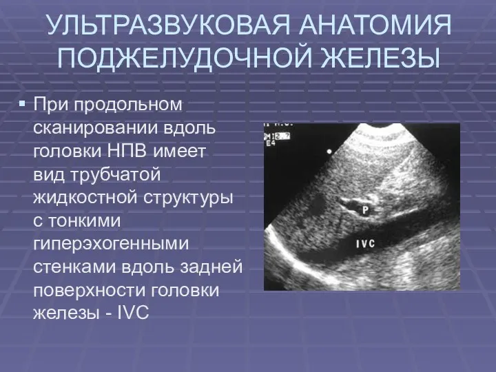 УЛЬТРАЗВУКОВАЯ АНАТОМИЯ ПОДЖЕЛУДОЧНОЙ ЖЕЛЕЗЫ При продольном сканировании вдоль головки НПВ