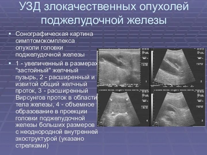 УЗД злокачественных опухолей поджелудочной железы Сонографическая картина симптомокомплекса опухоли головки