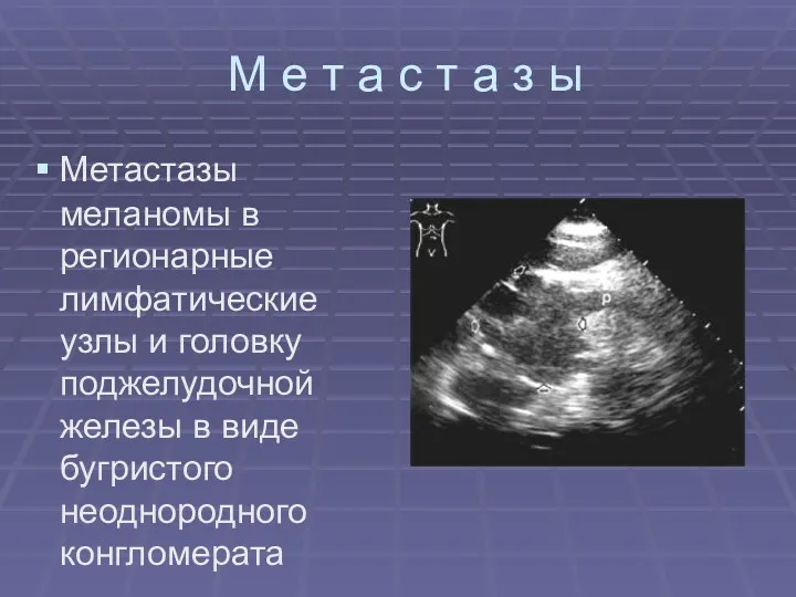 М е т а с т а з ы Метастазы