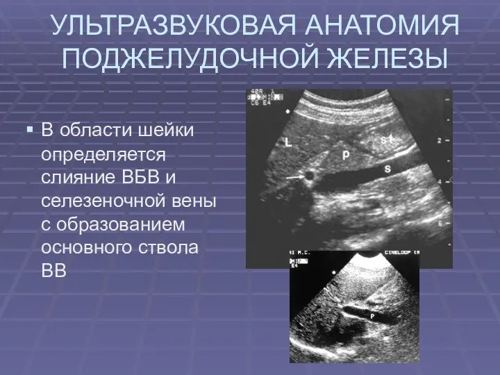 УЛЬТРАЗВУКОВАЯ АНАТОМИЯ ПОДЖЕЛУДОЧНОЙ ЖЕЛЕЗЫ В области шейки определяется слияние ВБВ